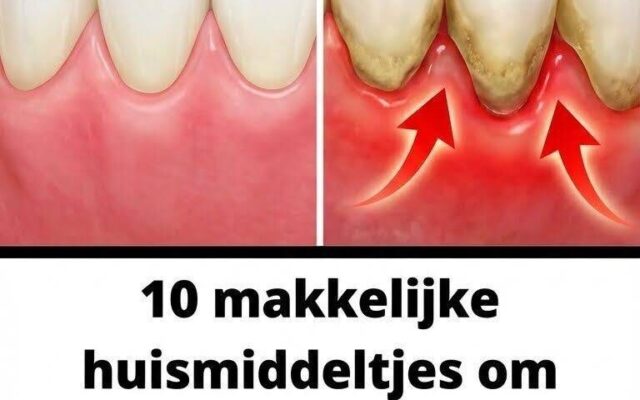 De vervelende impact van irriterend en gevoelig tandvlees