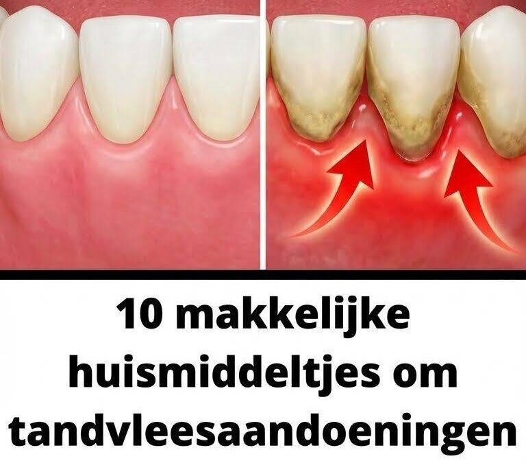 De vervelende impact van irriterend en gevoelig tandvlees
