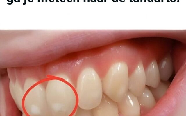 Als je Tanden zo zijn met Witte Vlekken, ga Je gaat Meteen naar de Tandarts!