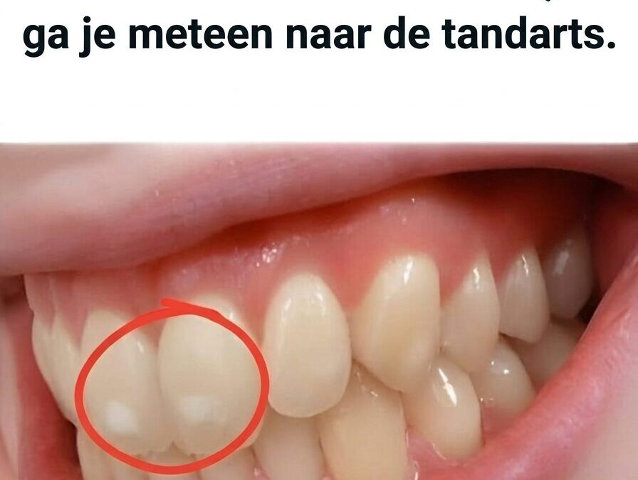 Als je Tanden zo zijn met Witte Vlekken, ga Je gaat Meteen naar de Tandarts!